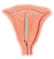 nitroděložní tělísko možná snižuje riziko vzniku rakoviny děložního čípku (zdroj: Wikimedia Commons)
