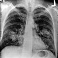 snímek hrudníku pacienta s rakovinou plic (zdroj: wikipedia.org)