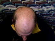 riziko rakoviny prostaty je možná nižší u mužů, kterým začaly vypadávat vlasy již v mládí (zdroj: wikipedia.org)