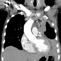 CT snímek hrudníku pacienta s mezoteliomem (zdroj: wikipedia.org)