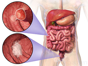 Blausen 0246 ColorectalCancer