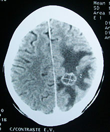CT image of a brain tumour (source: wikipedia.org)