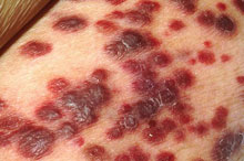 Kaposiho sarkom na kůži pacienta s AIDS (ilustrační obrázek: wikipedia.org)