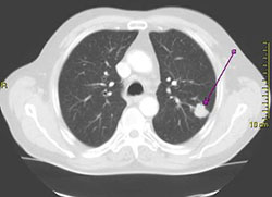 CT scan zobrazující zhoubný nádor v plíci (zdroj: wikipedia.org)
