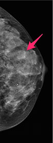 Case courtesy of Dr Garth Kruger, Radiopaedia.org, rID: 29321