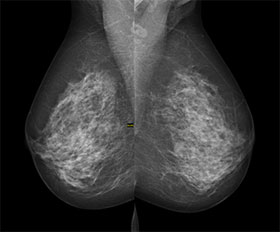 příklad mamogramu (zdroj: wikipedia.org)