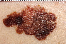 melanom způsobuje většinu případů úmrtí na rakovinu kůže (zdroj: wikipedia.org)
