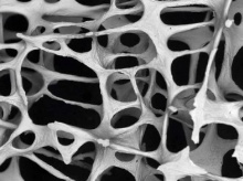 mikrofotografie kosti postižené osteoporózou (zdroj: wikipedia.org)